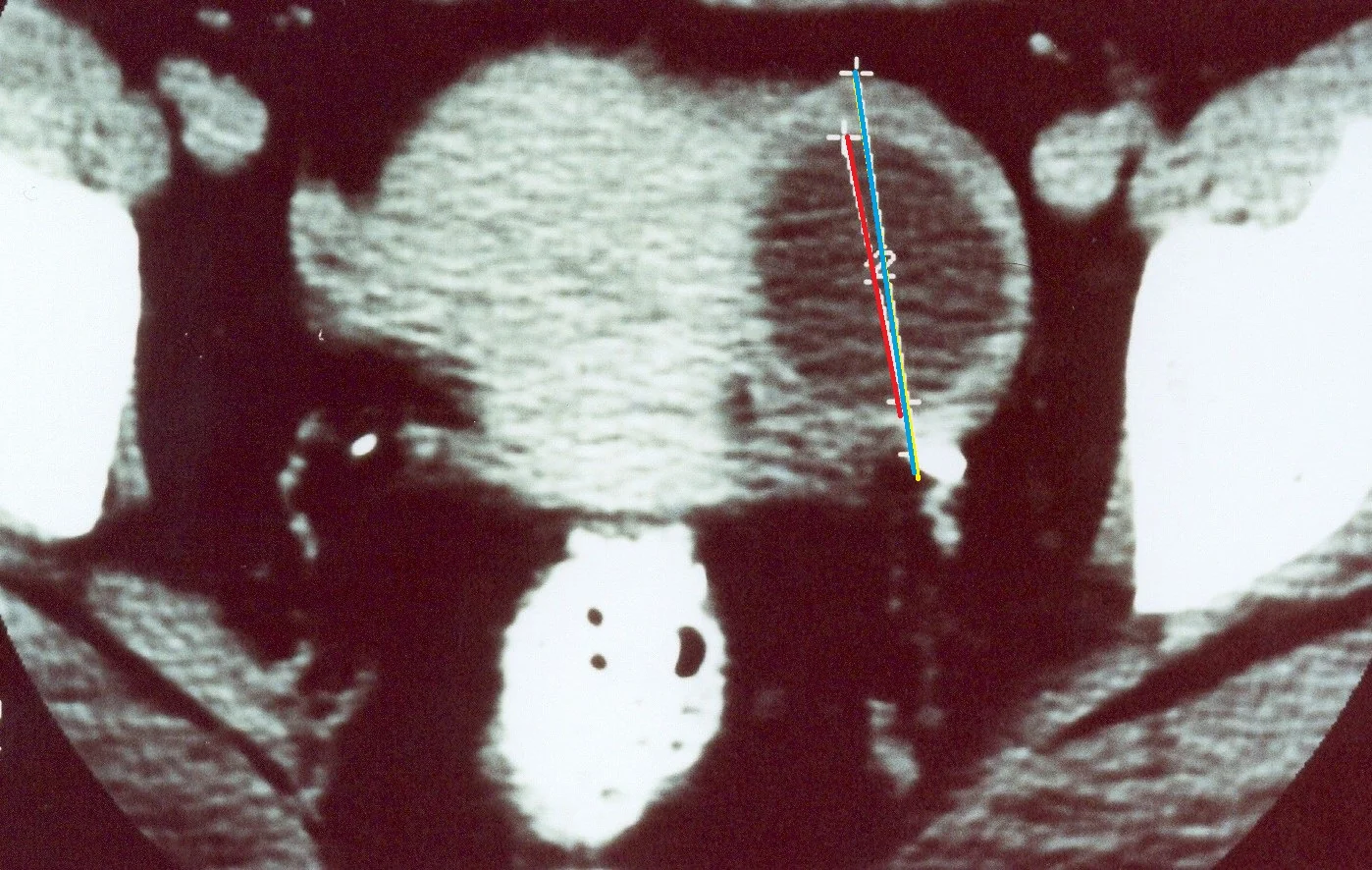 SIGMOID CARCINOMA RECURRENCE