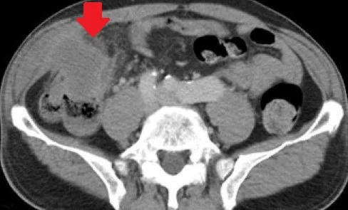 AMOEBIC ABSCESS - CECAL PERFORATION