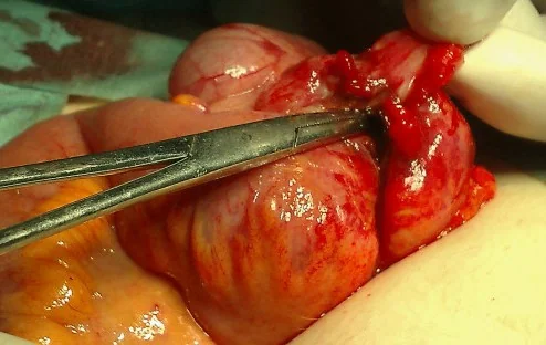 PERFORATION OF CECAL DIVERTICULUM