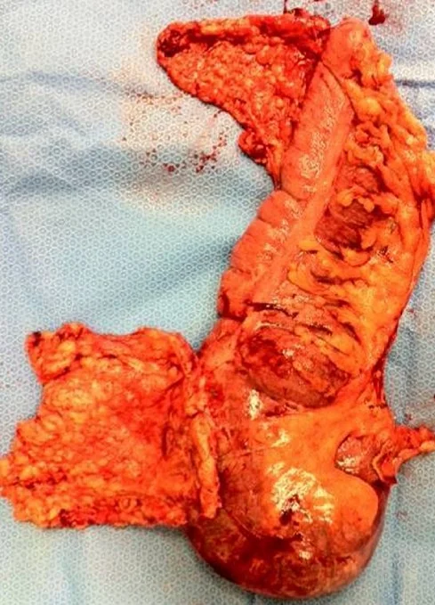 POSTPARTUM CECAL PERFORATION