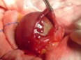 CECAL PERFORATION 
