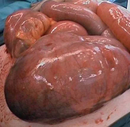 CECAL VOLVULUS