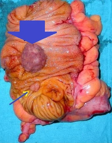 CECAL INFLAMMATORY MYOGLANDURAL POLYP