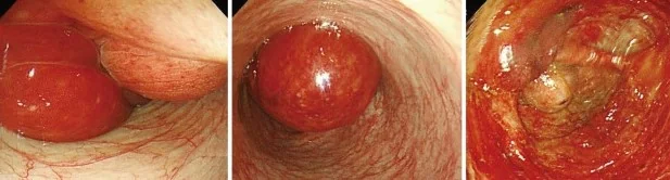 COLO-COLONIC INTUSSUSCEPTION