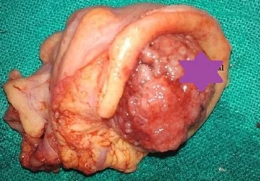COLO-COLONIC INTUSSUSCEPTION 