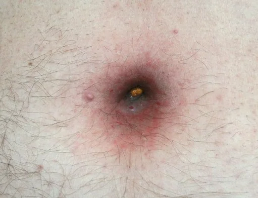 COLOCUTANEOUS FISTULA