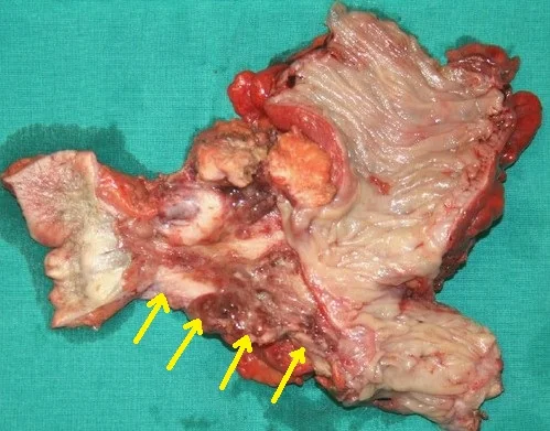 EXCISION OF COLOCUTANEOUS FISTULA 