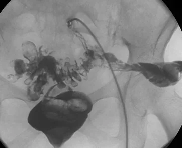 FISTULOGRAPHY
