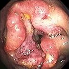 COLONIC ADENOCARCINOMA