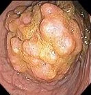 COLONIC ADENOCARCINOMA