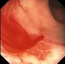 COLONIC DIEULAFOY