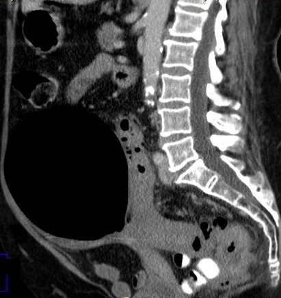 COLONIC DIVERTICULUM