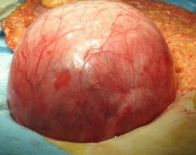 COLONIC DIVERTICULUM