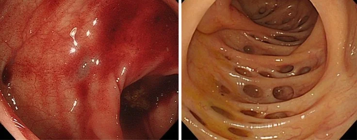 COLONIC DIVERTICULA