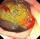 COLONIC EROSION - VASCULAR GRAFT