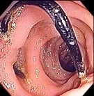 COLONIC FOREIGN BODY
