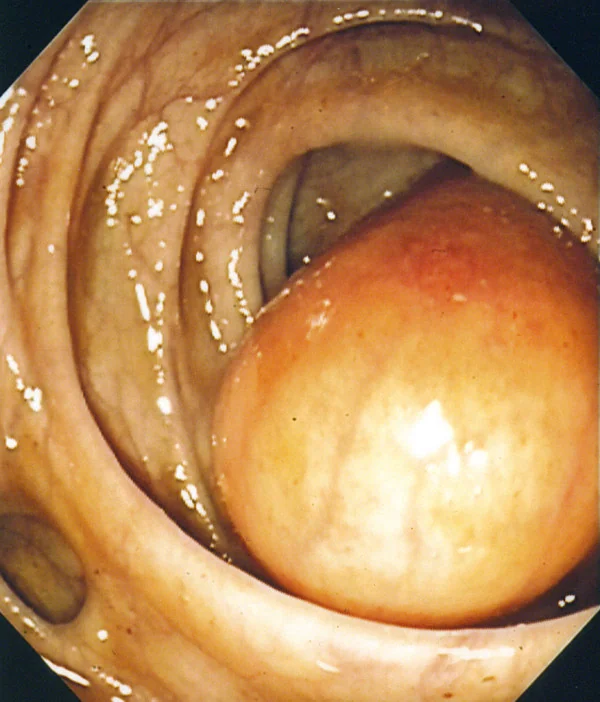 COLONIC GANGLIONEUROMA