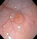 COLONIC HAMARTOMA