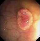 COLONIC HYPERPLASTIC POLYP
