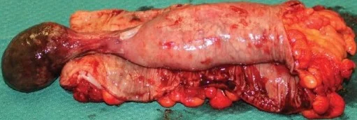 COLONIC INTUSSUSCEPTION - LIPOMA