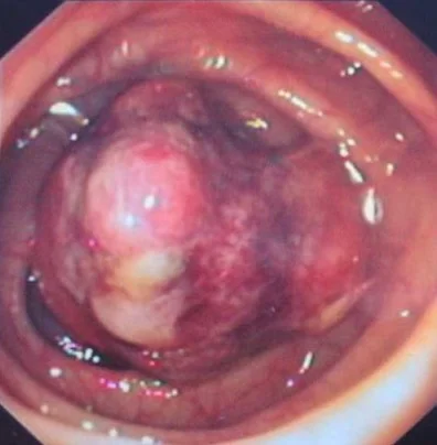 COLONIC LIPOMA