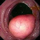 COLONIC LIPOMA