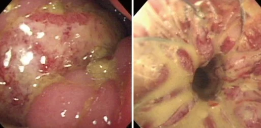 COLONIC MUCINOUS ADENOCARCINOMA
