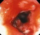 POST R/T COLONIC STRICTURE
