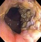 COLONIC SQUAMOUS CARCINOMA