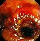 COLONIC STENT