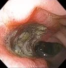 COLONIC ULCER