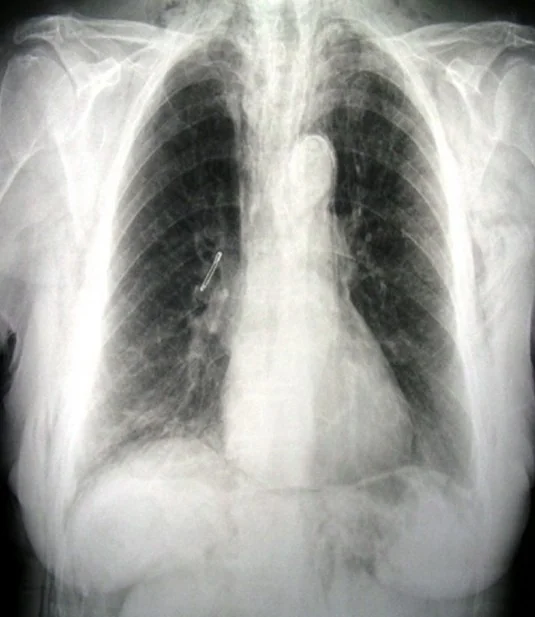 COLONOSCOPY - SUBCUTANEOUS EMPHYSEMA