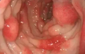 CRONKHITE CANADA SYNDROME