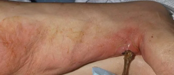 RECTAL ANASTOMOSIS DEHISCENCE - POPLITEAL FOSSA FISTULA