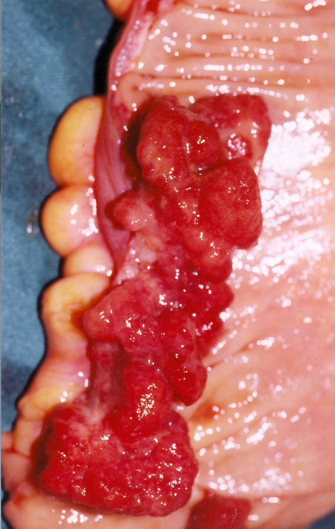 RECTAL CARCINOMA