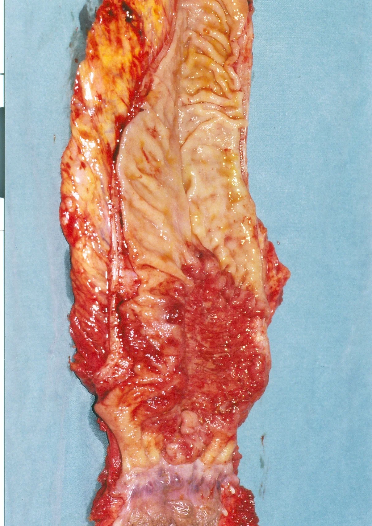 RECTAL CARCINOMA