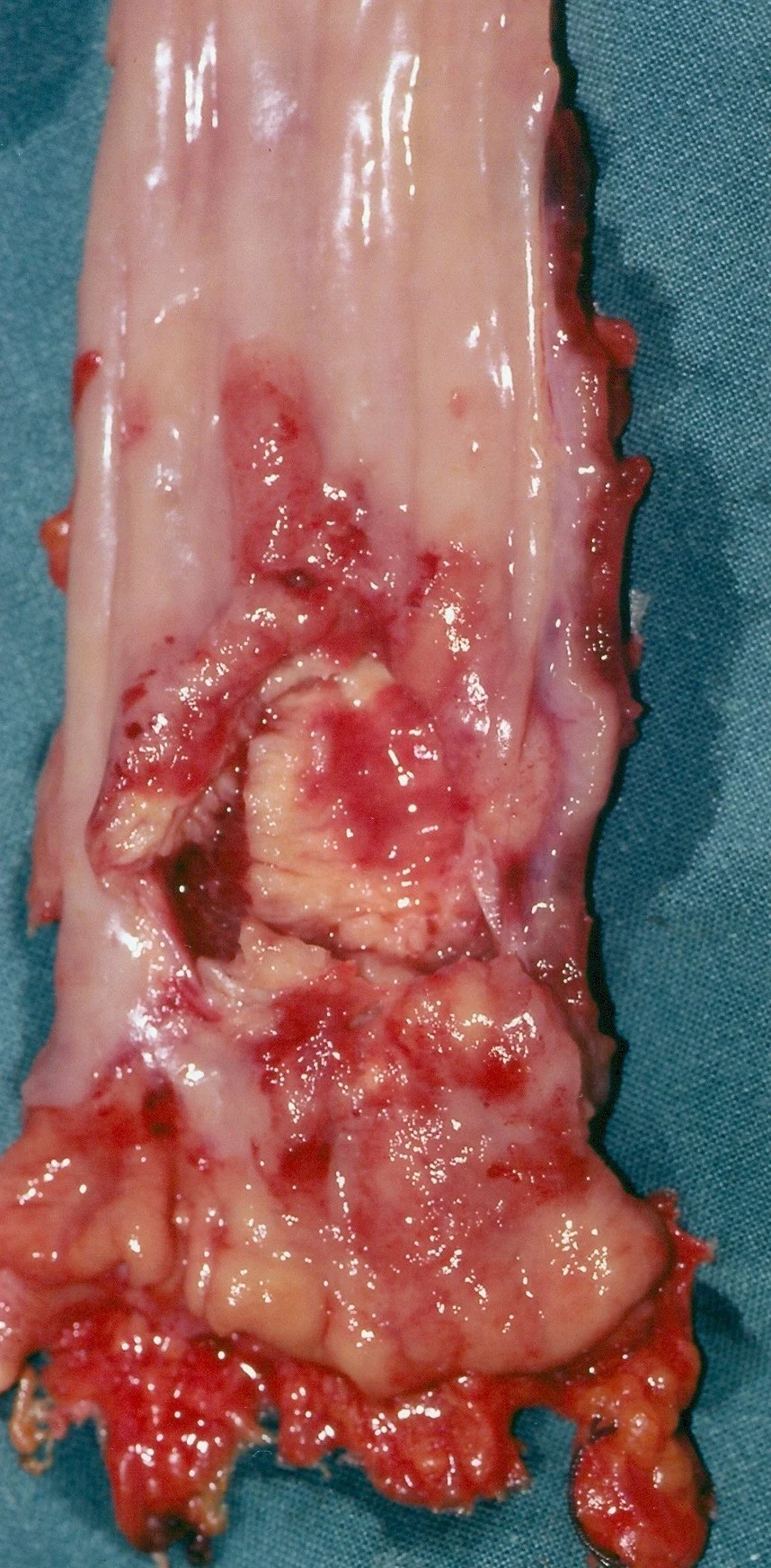 RECTAL CARCINOMA - PRE-OP R/T