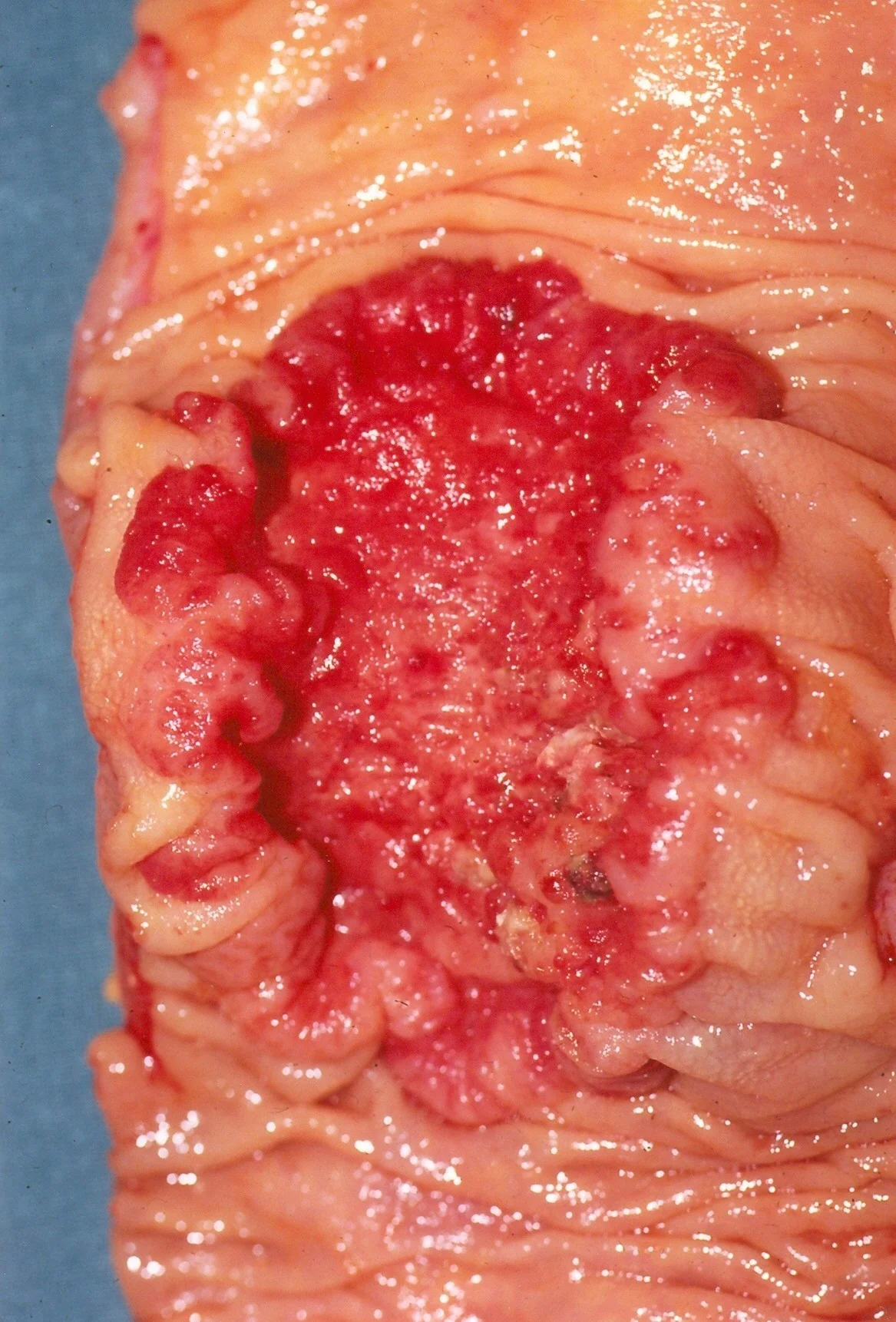 RECTAL CARCINOMA