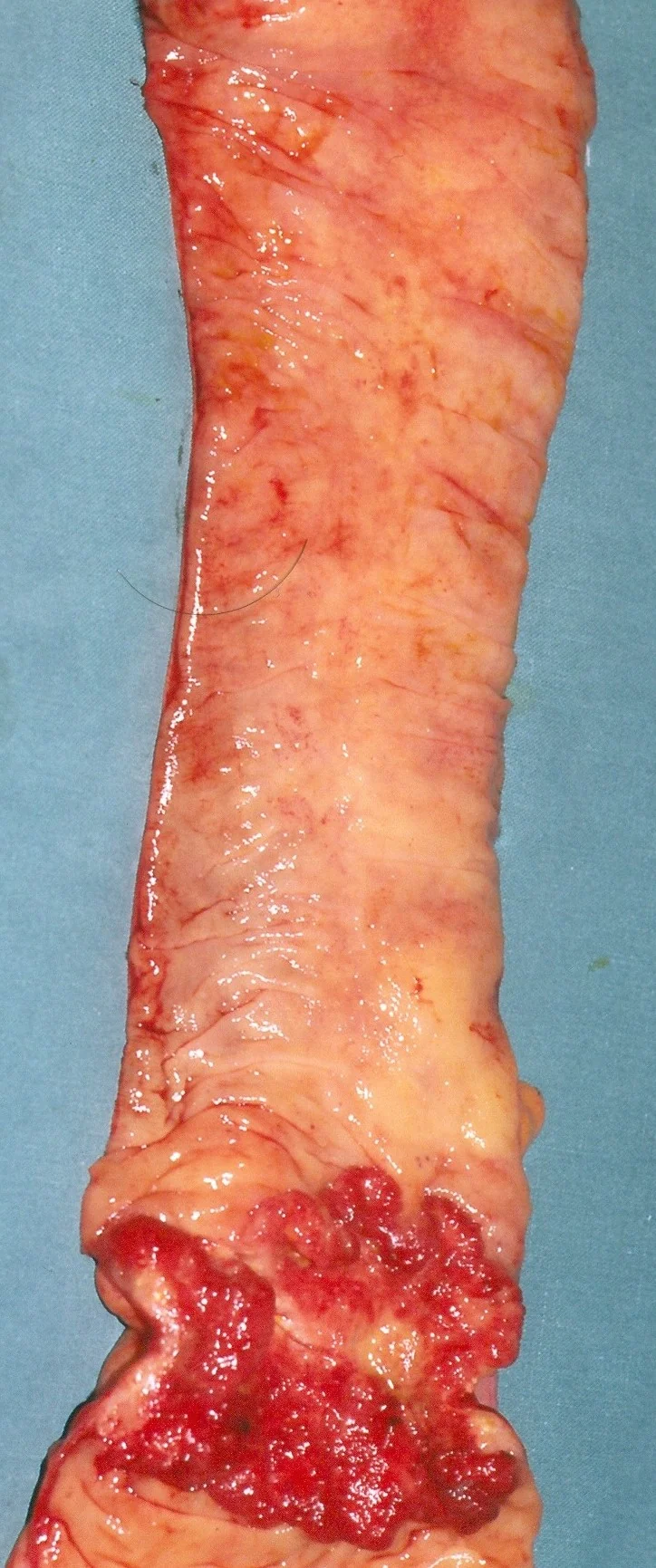 RECTAL CARCINOMA - PRE-OP R/T
