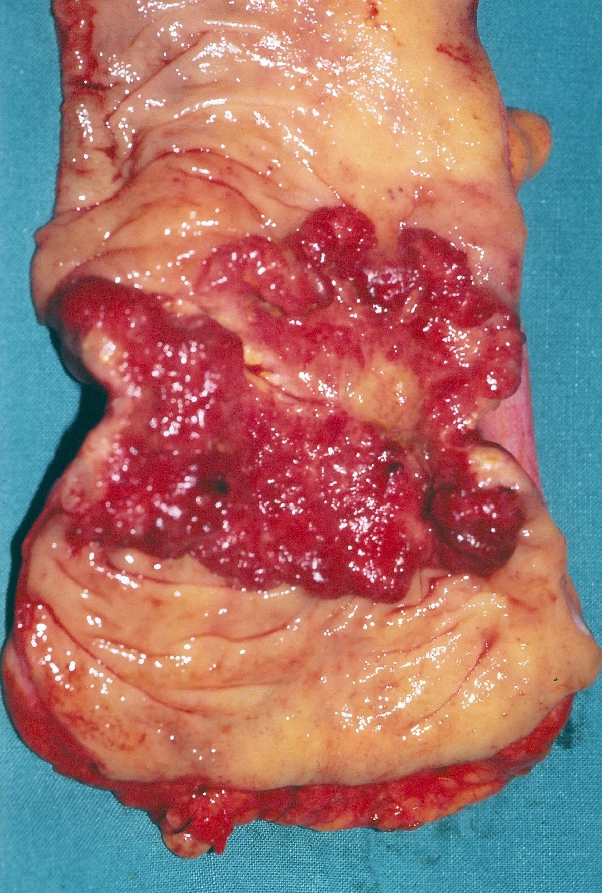 RECTAL CARCINOMA