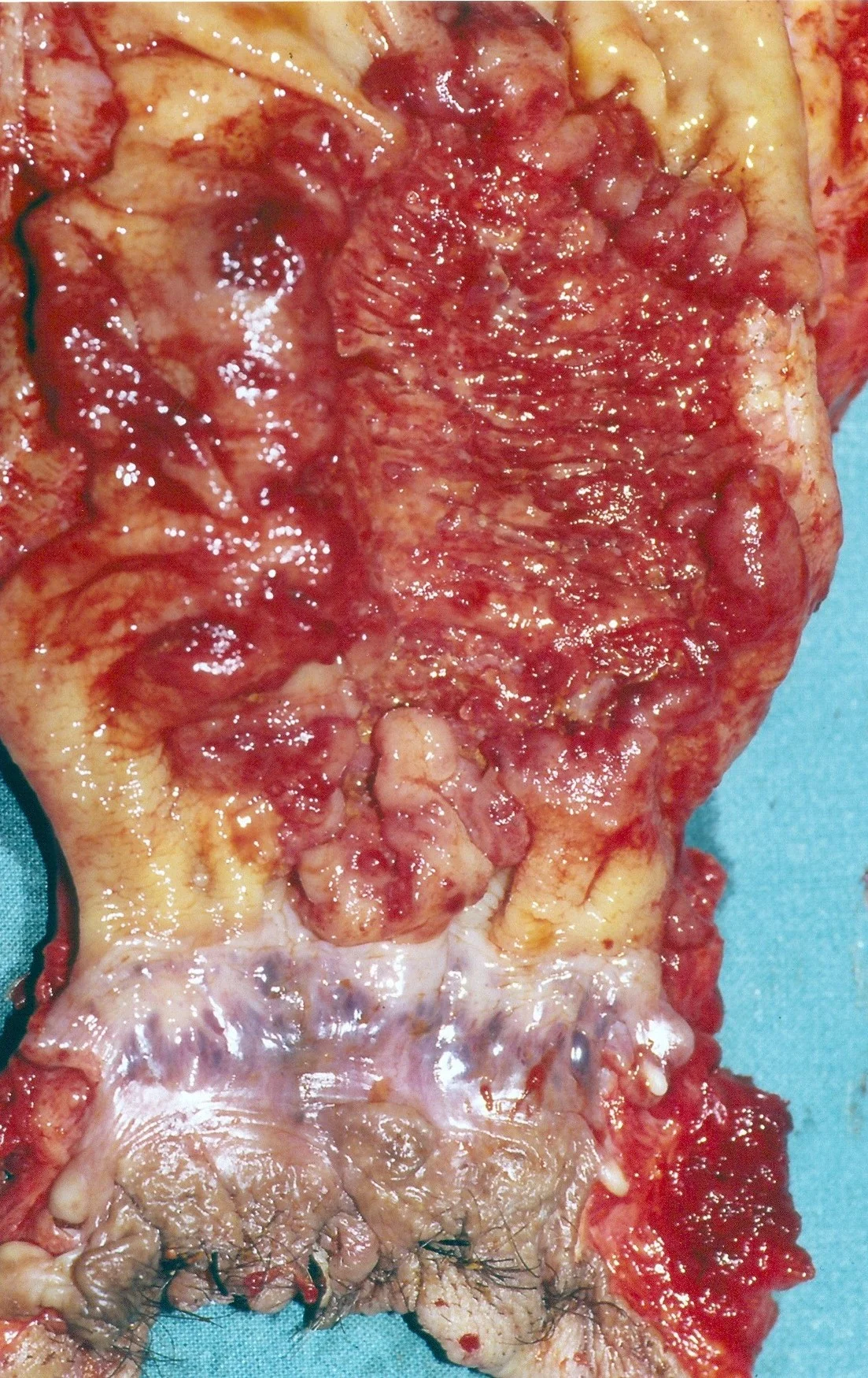 ANO-RECTAL JUNCTION CARCINOMA