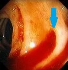 BLEEDING DIVERTICULUM