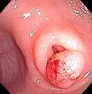 DIVERTICULAR POLYP
