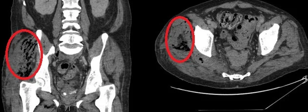 DIVERTICULITIS - THIGH ABSCESS