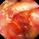 DIVERTICULITIS