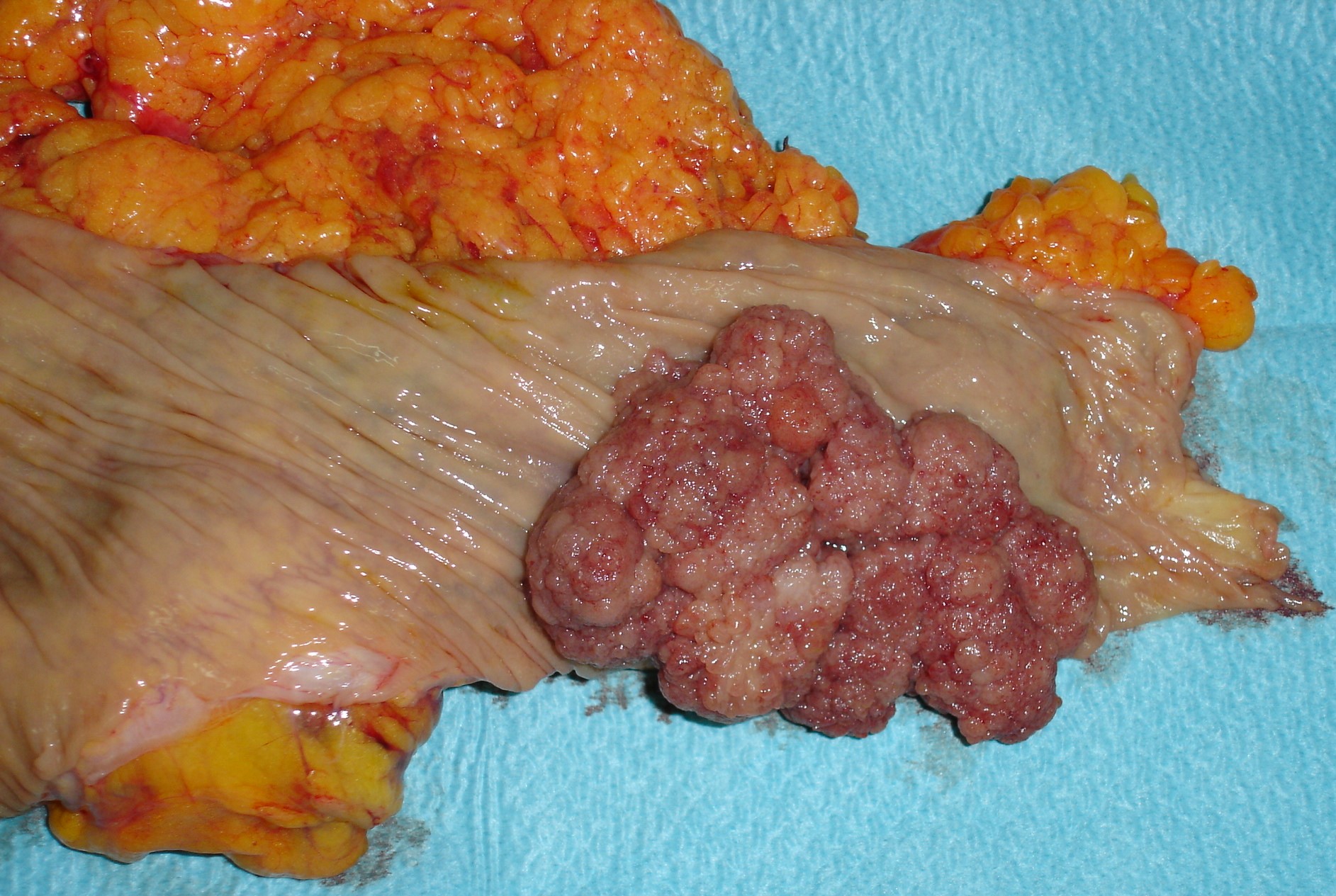 TRANSVERSE COLON CARCINOMA