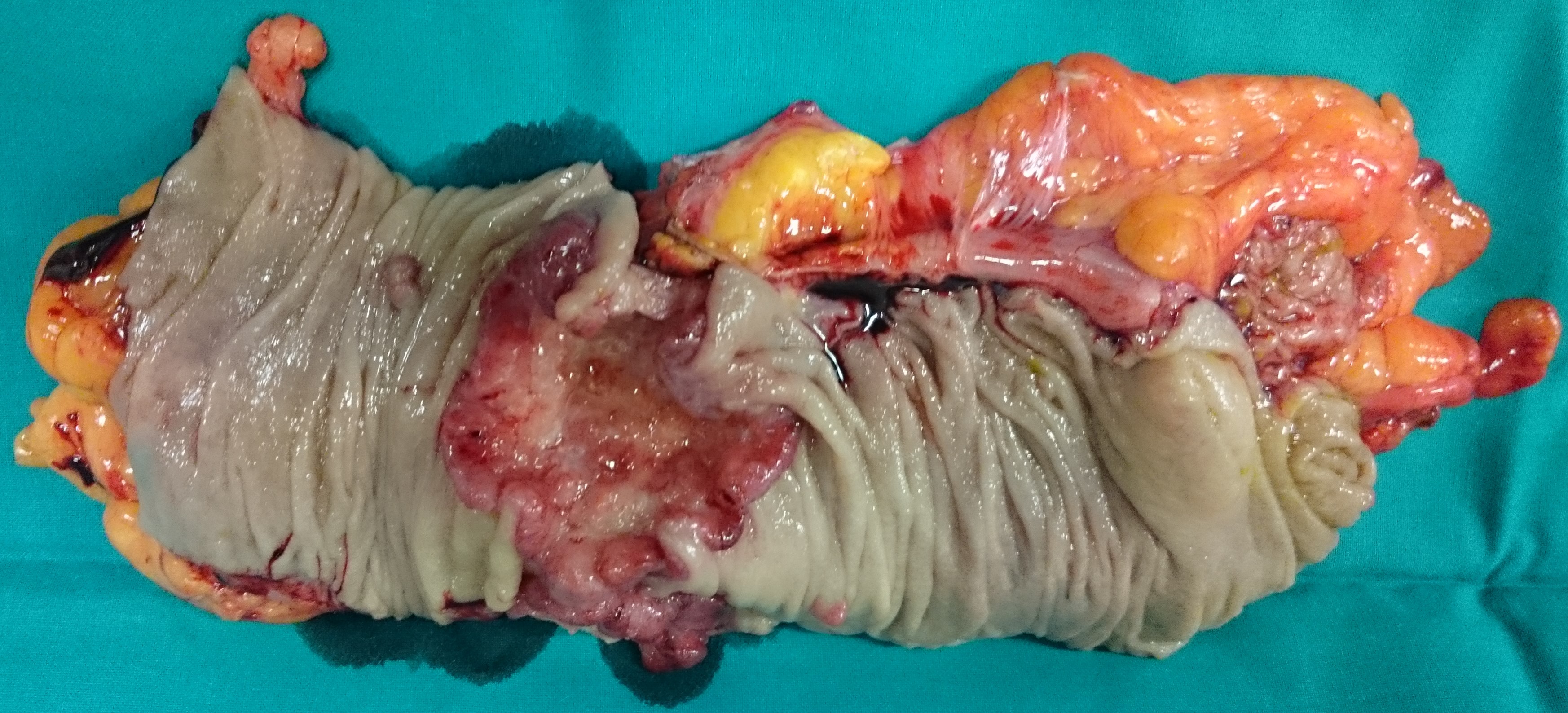 TRANSVERSE COLON CARCINOMA