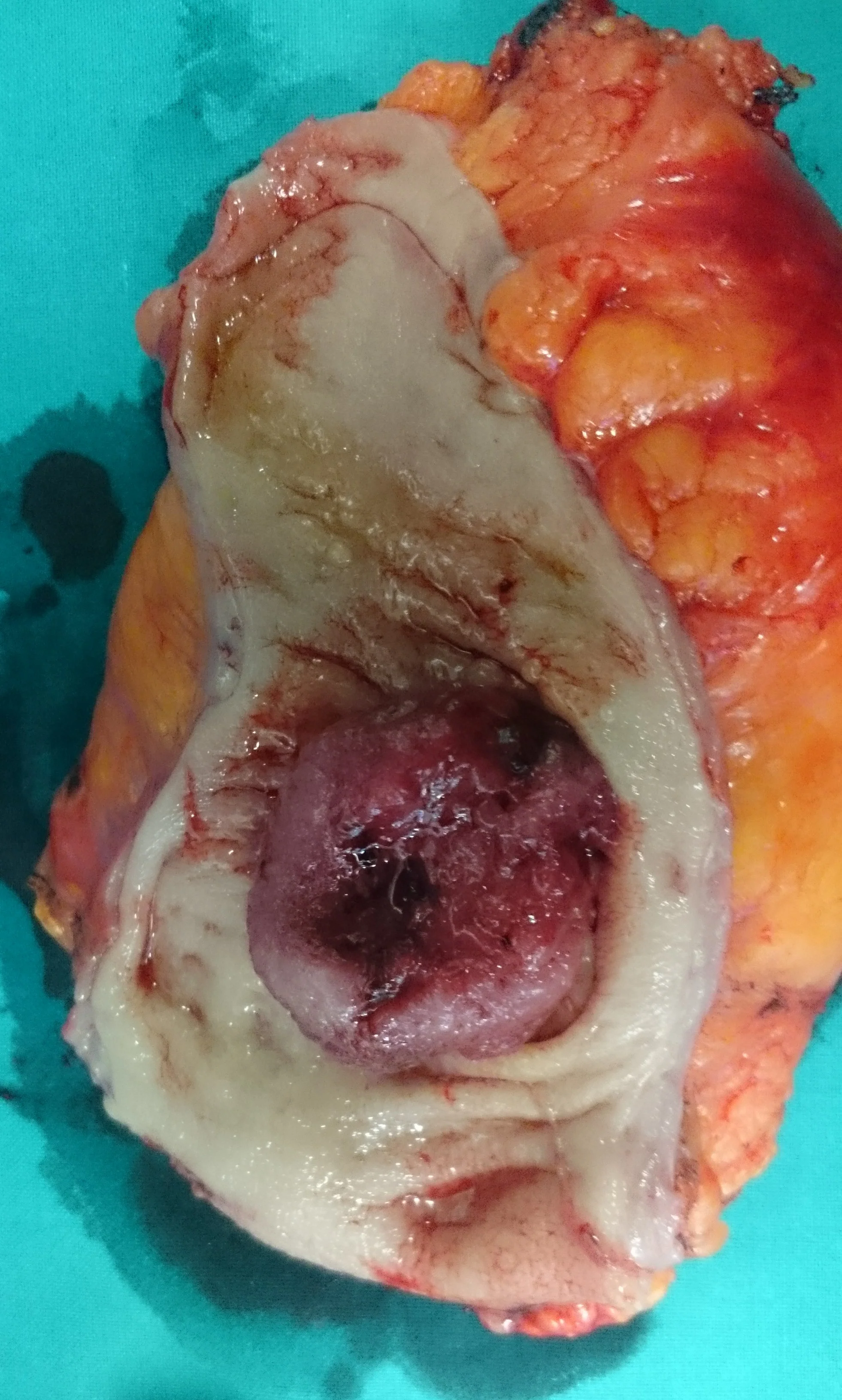 SIGMOID COLON CARCINOMA