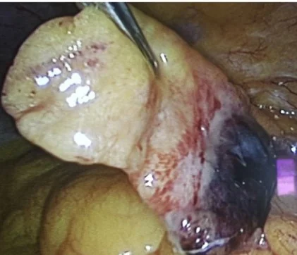 EPIPLOIC APPENDAGITIS