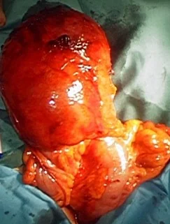 GIANT SIGMOID DIVERTICULUM